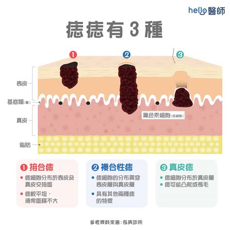 長毛痣|痣形成的原因？痣長毛、痣變多變大是痣病變？5招判。